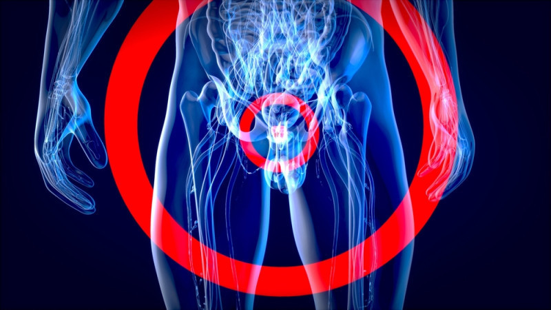 A translucent blue human silhouette highlighting the pelvic area, overlaid with a large red target symbol focusing on the center.